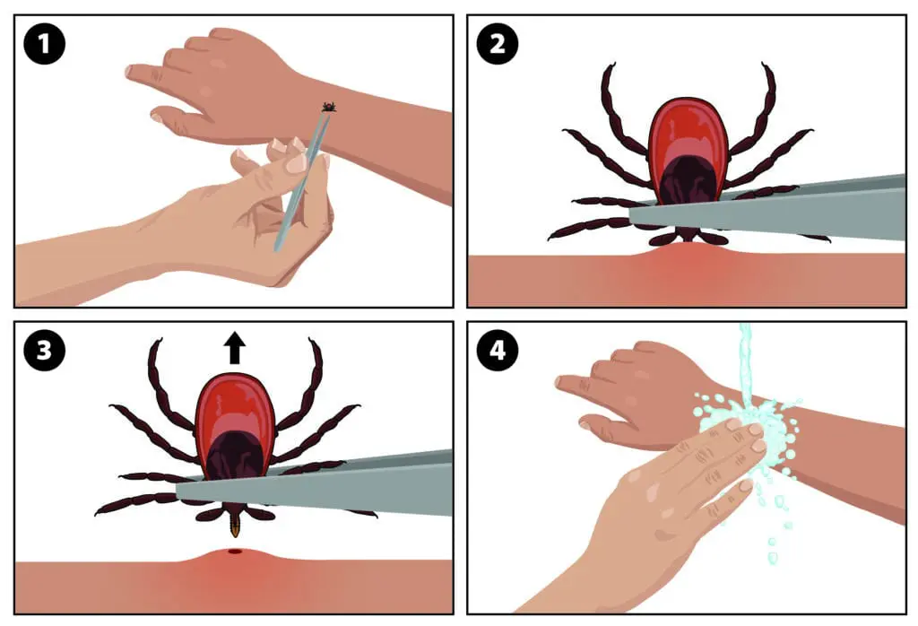 how to remove a tick safely, tick removal steps from CDC