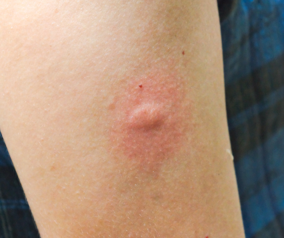 mosquito bite on human skin red bug bite 