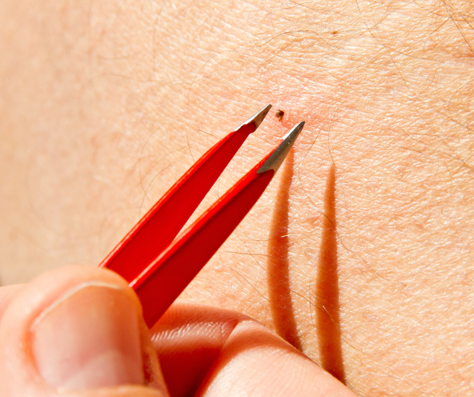 fine point tweezers for tick removal