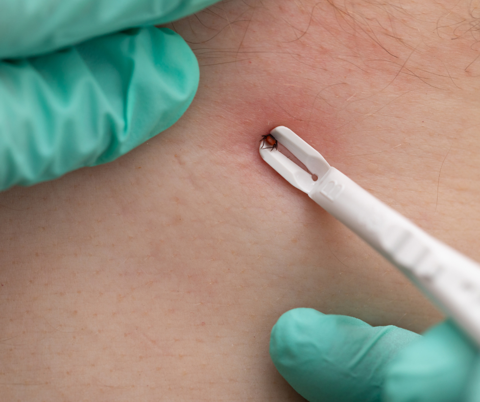 how to remove a tick safely tick removal tool