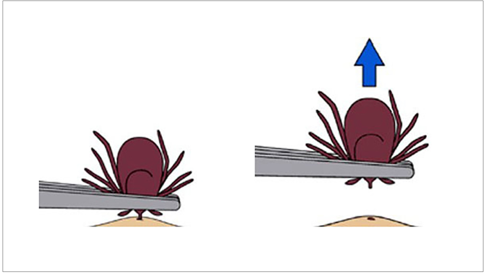 how to safely remove a tick, how to remove a tick safely