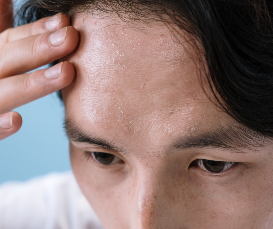 sweaty forehead 