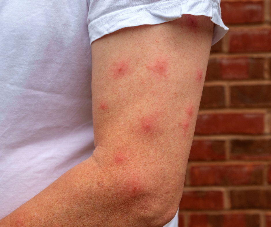 arm covered in mosquito bites 