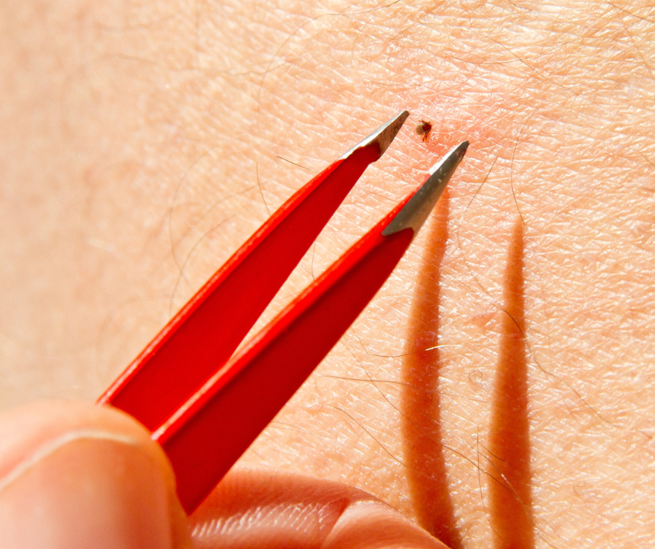 A person uses red tweezers to carefully remove a tiny tick from irritated skin.