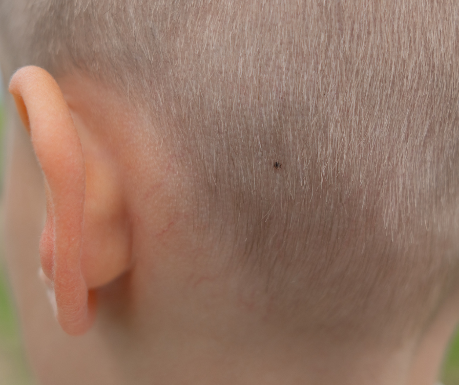 A small, dark tick is embedded in the light-colored hair on a child's