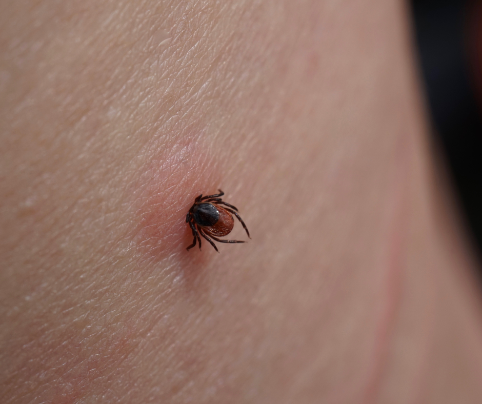 A small tick is embedded in human skin, causing a red irritation.