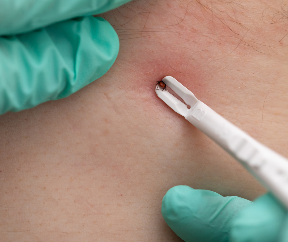 A gloved hand uses a white tool to remove a small tick from inflamed skin.