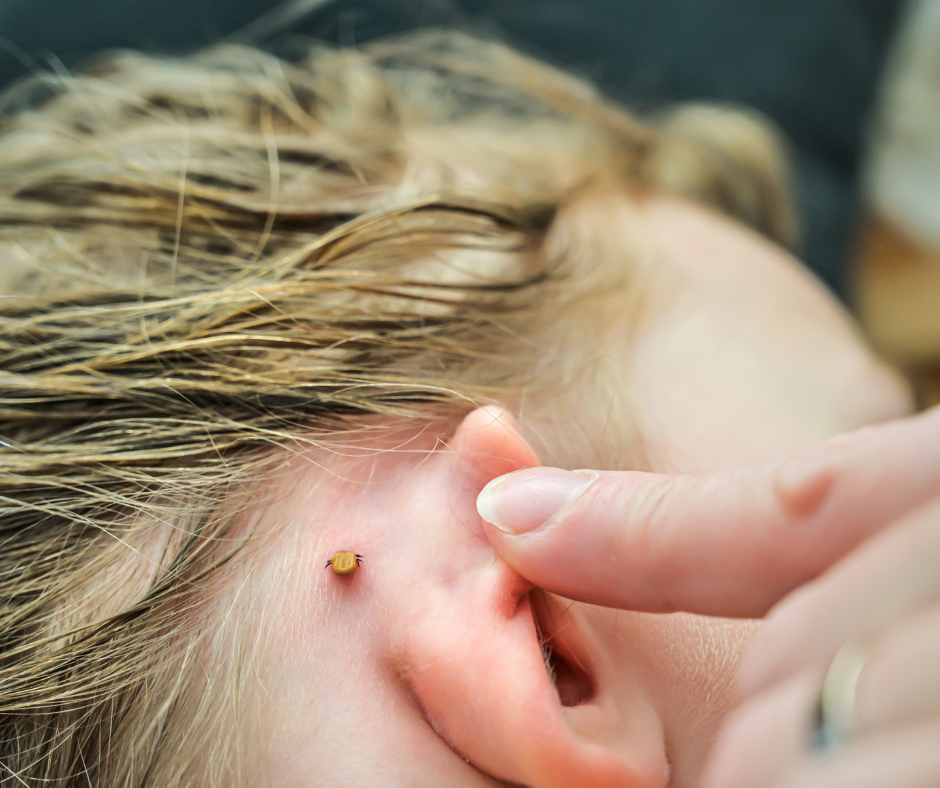 A finger points to an engorged tick embedded in the skin behind a child's ear